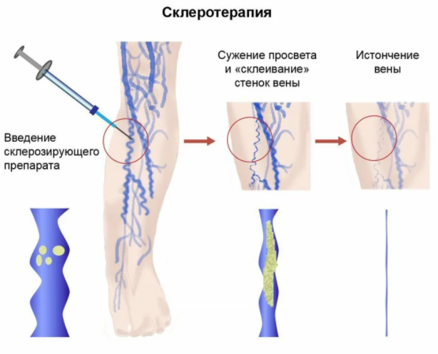 этапы склеротерапии