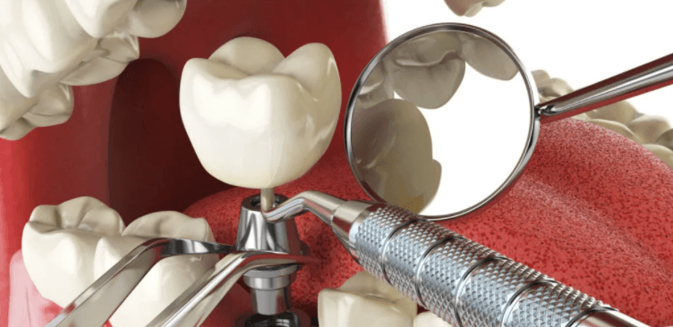 имплантация зубов в медицинском центре ProudClinic