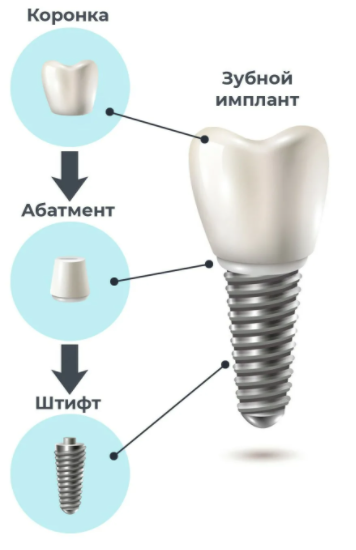 структура зубного импланта