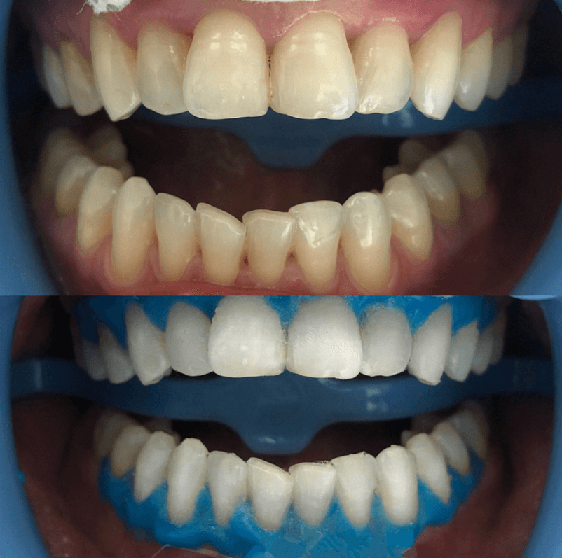 отбеливание зубов до и после