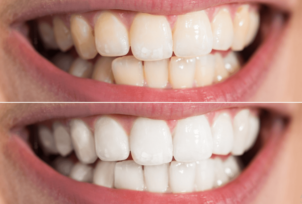 результат отбеливания зубов