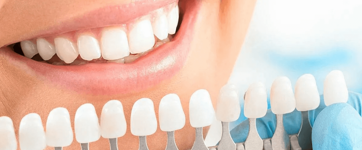 отбеливание зубов в минске