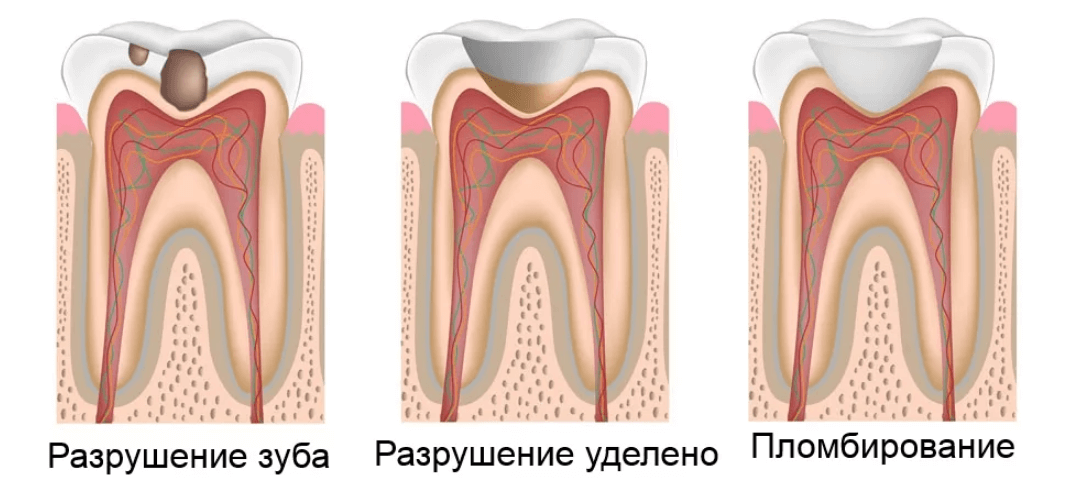 Этапы пломбирования зубов