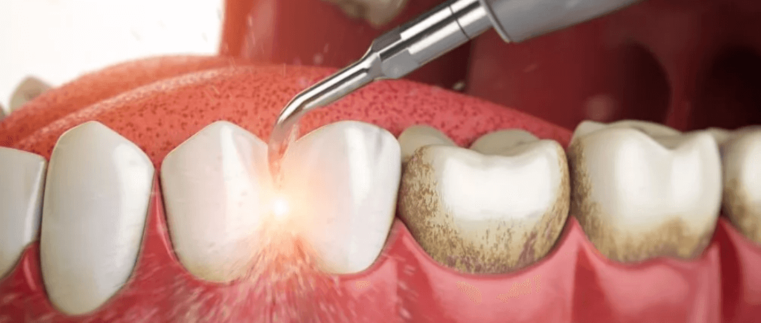 удаление зубного камня